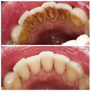 teeth cleaning in jamshedpur