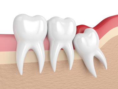 wisdom tooth removal in jamshedpur