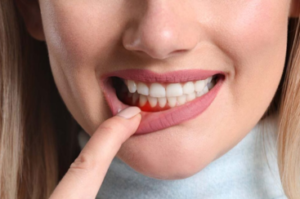 bleeding gum treatment