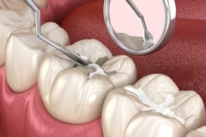 pit fissure sealants in jamshedpur