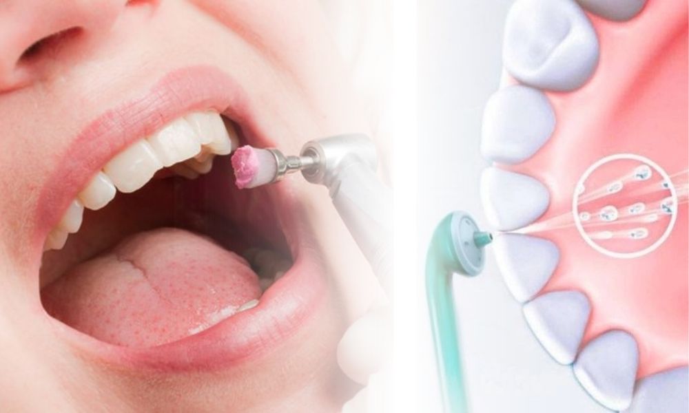 teeth cleaning