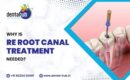 Root Canal Treatment Jamshedpur
