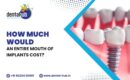 full mouth implant cost in jamshedpur