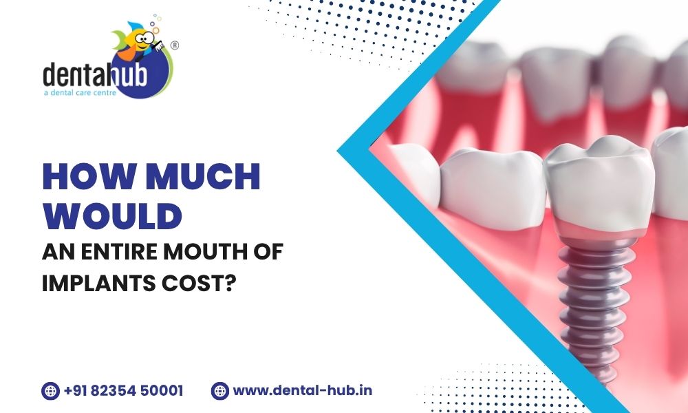 full mouth implant cost in jamshedpur